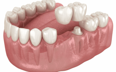  ¿Cuándo es necesario un tratamiento de rehabilitación oral?