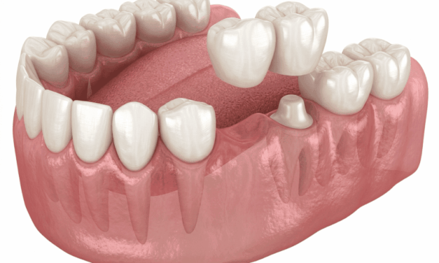  ¿Cuándo es necesario un tratamiento de rehabilitación oral?